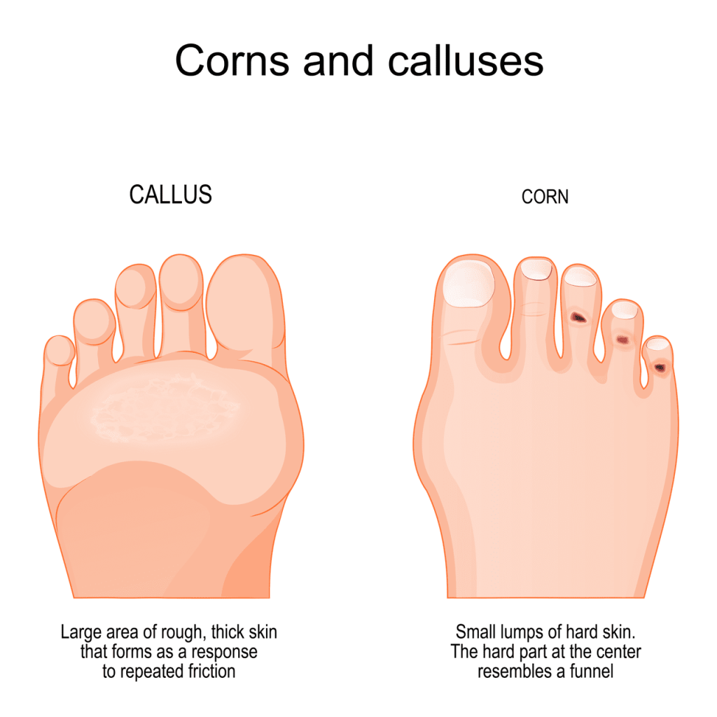 Showing Corns and Calluses on feet