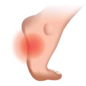 Showing the Arch Pain Position with red Color on foot
