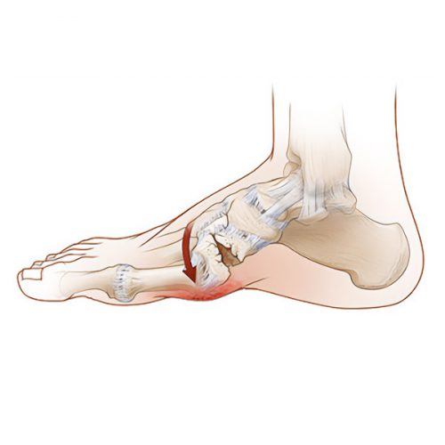 X-Ray of Charcot Foot