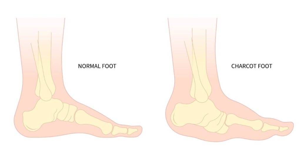 X-Ray of Normal Foot or Charcot Foot